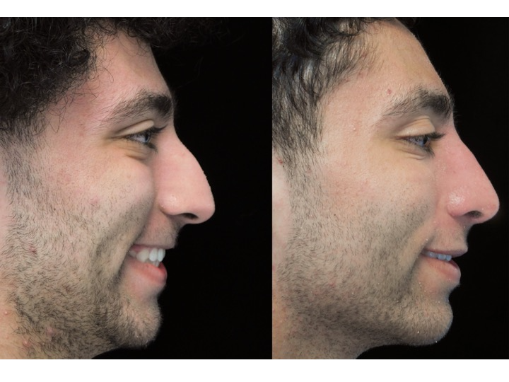 Illustration of a man with wide nasal bones who underwent a closed rhinoplasty