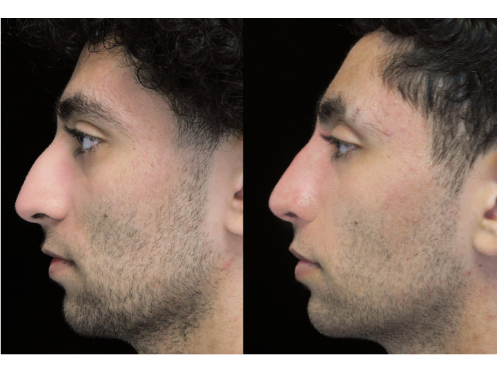 Before and after photo of a man who underwent bulbous nasal tip rhinoplasty