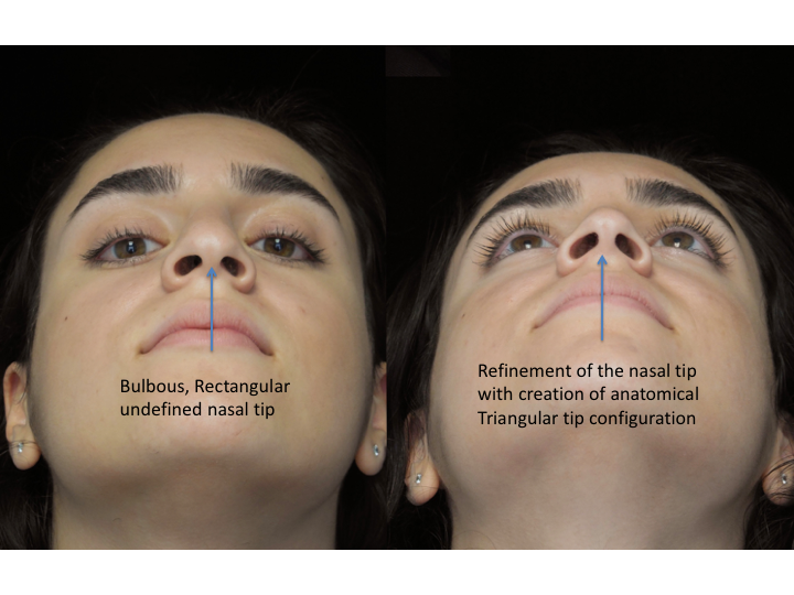 Illustration of a woman who underwent bulbous nasal tip rhinoplasty
