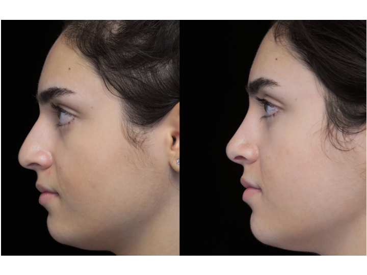 Illustration of a woman who  underwent bulbous nasal tip rhinoplasty