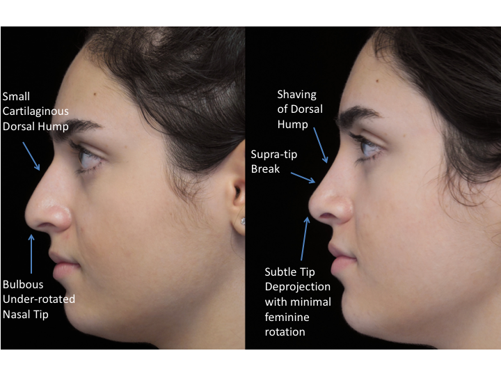 Illustration of a woman who underwent bulbous nasal tip rhinoplasty