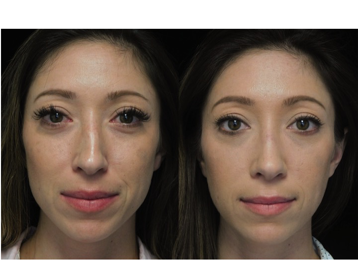 before and after photo of a woman who underwent a nose job tip reduction