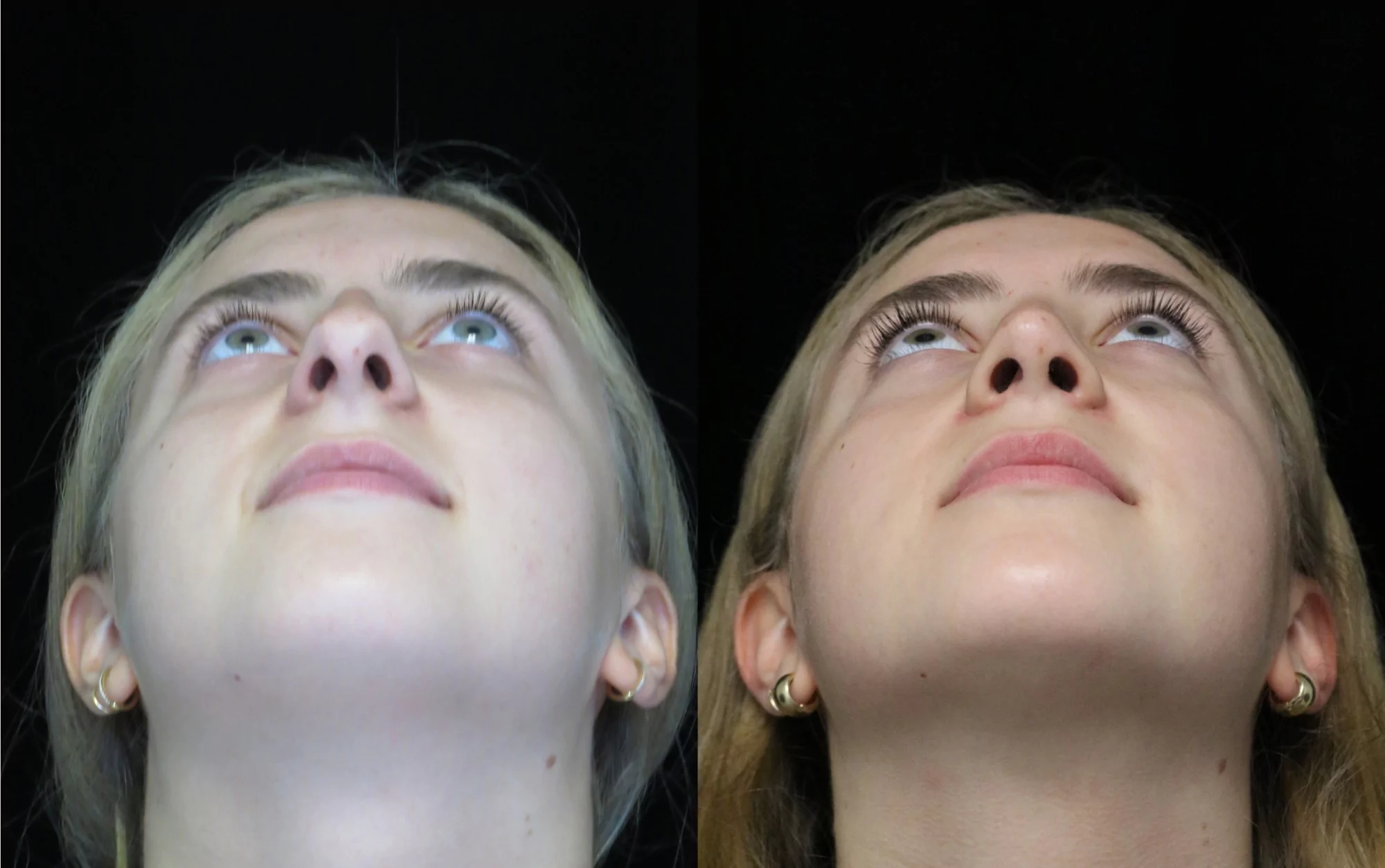 nose job before and after of a female with crooked nose