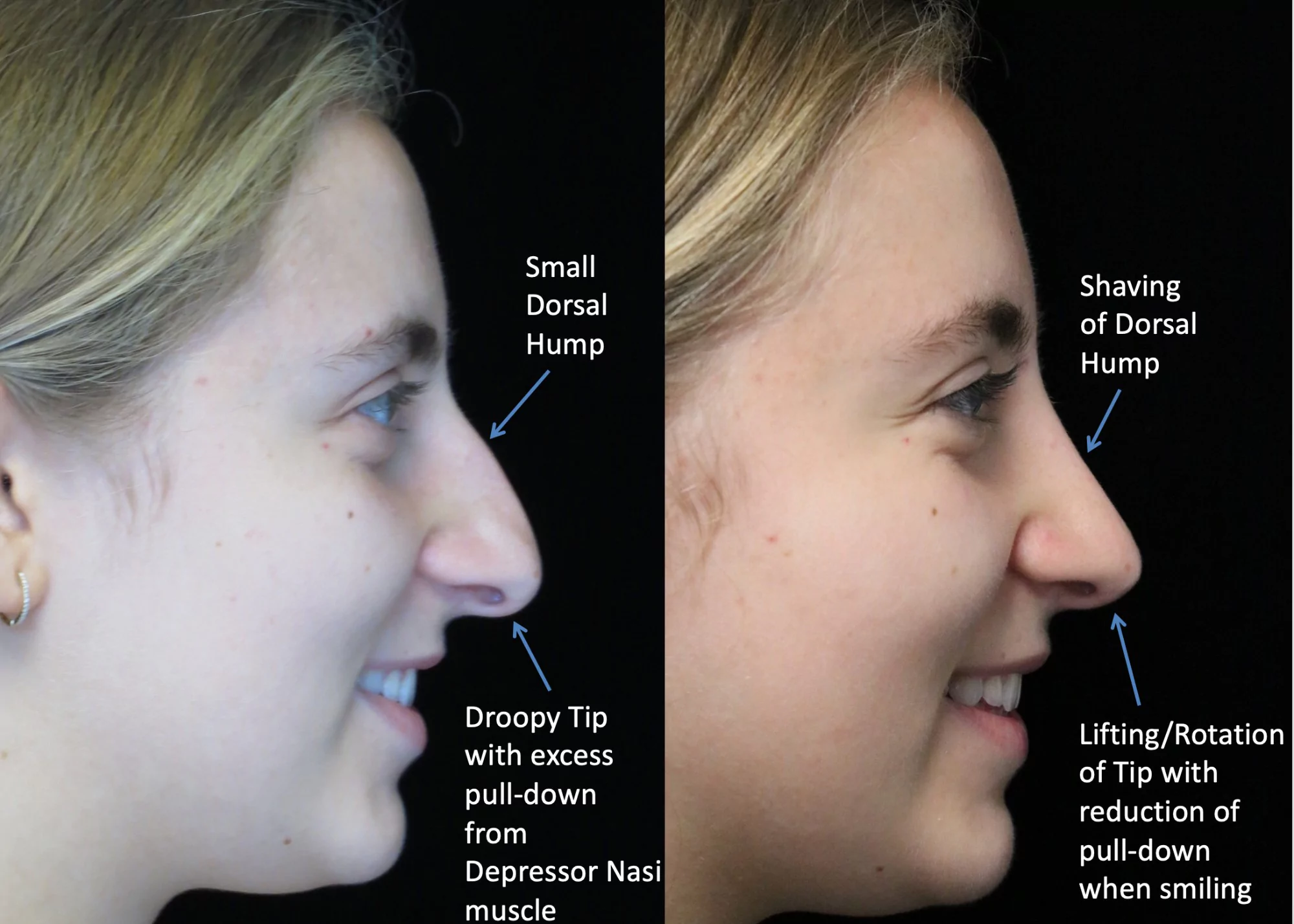 nose job before and after of a female with crooked nose