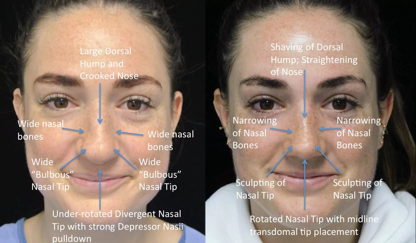 a woman who underwent rhinoplasty before and after illustration
