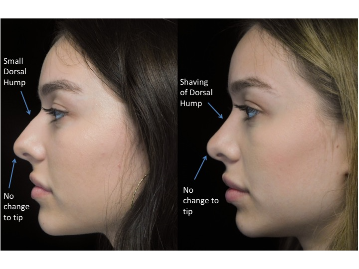 A woman who underwent rhinoplasty before and after illustration