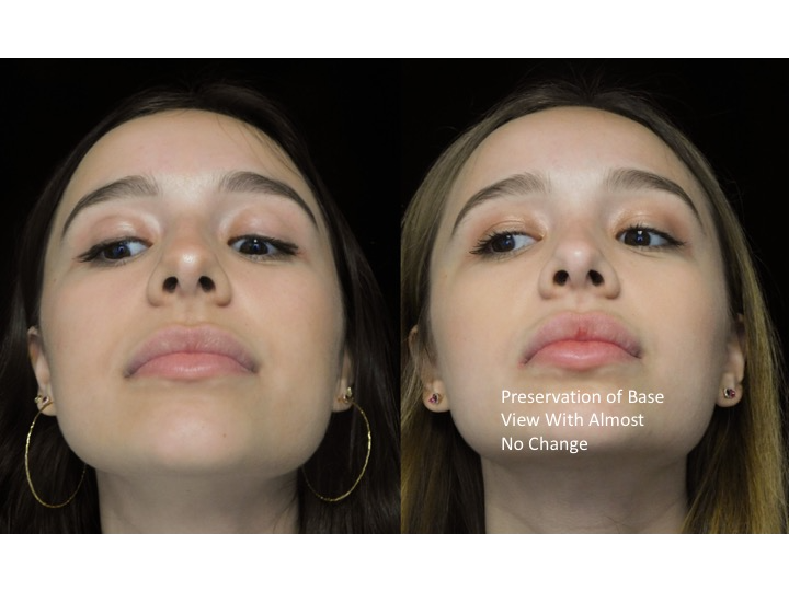 A woman who underwent rhinoplasty before and after illustration