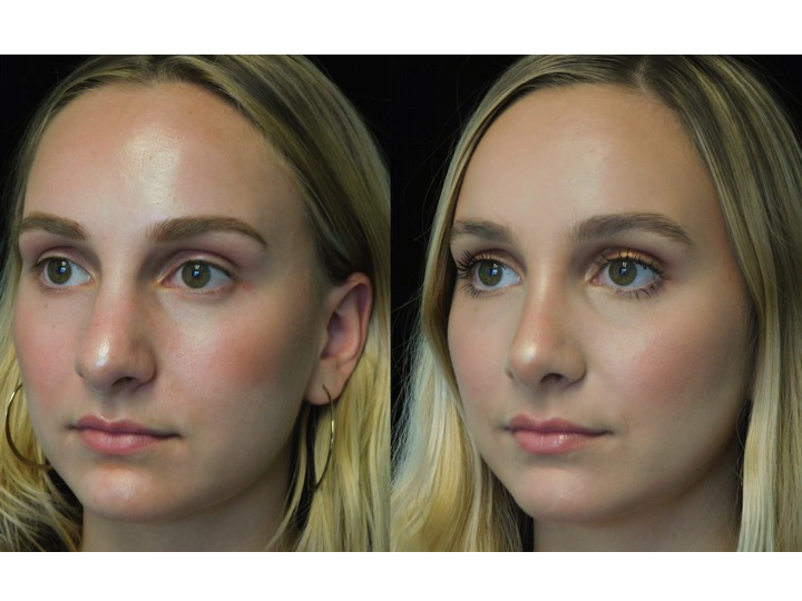 closed rhinoplasty before and after illustration of a woman with wide bulbous nasal tip