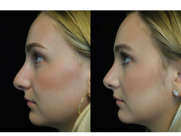 closed rhinoplasty before and after illustration of a woman with wide bulbous nasal tip