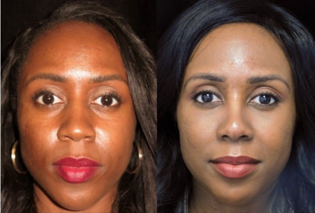 ethnic nose job before and after photo