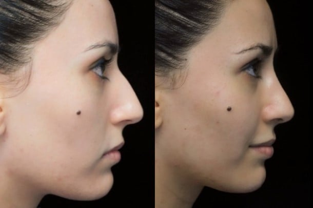 european nose job before and after photo