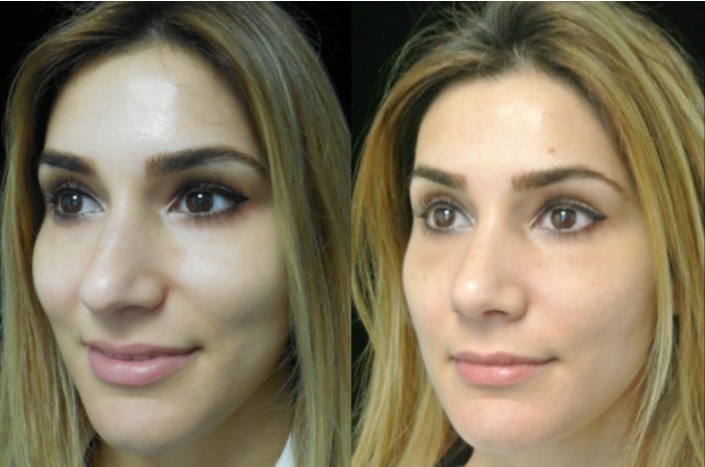 nose job before and after female