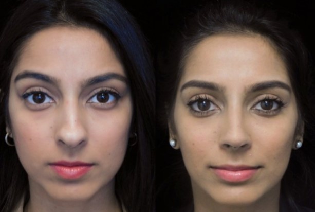 indian nose job before after photo