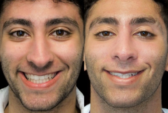 male nose job before and after photo