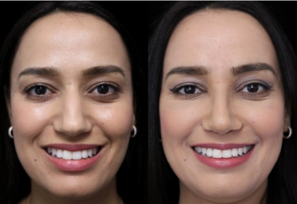 middle east rhinoplasty before and after photo