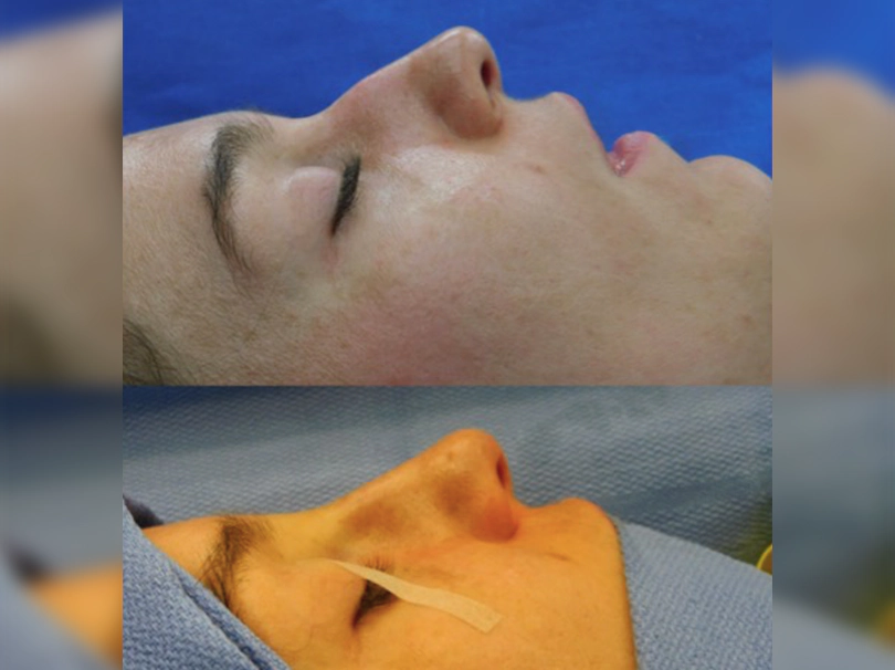 Rhinoplasty before and after photo of a female patient with excess tip projection