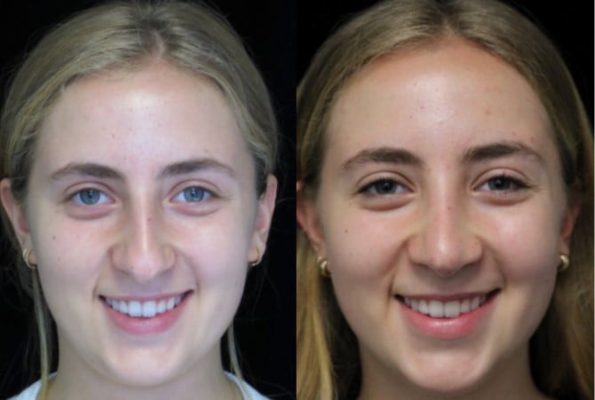 young female nose job before and after photo