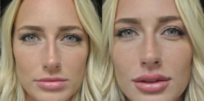 Lip Filler - Before and After of Dr. Dugar's patient