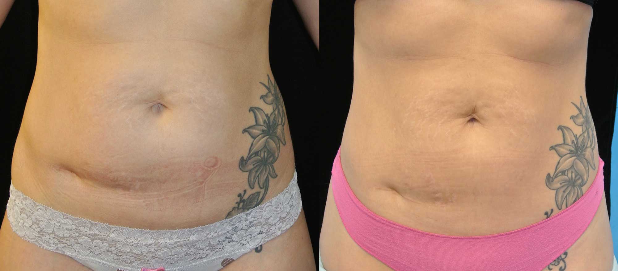 before and after close up photo of a female abdomen after a non surgical laser fat melting