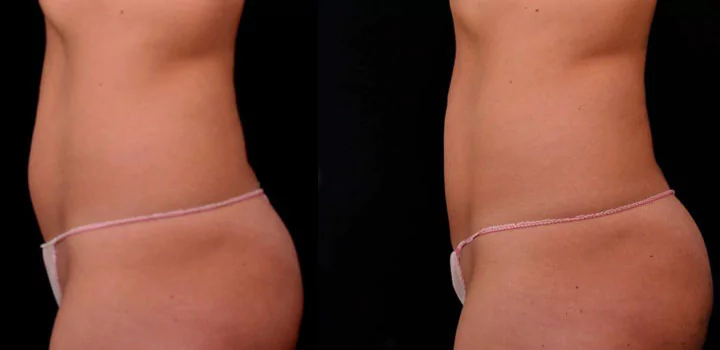 before and after right profile view photo of a female's abdomen that is flatter after 6 sessions of non surgical laser fat melting