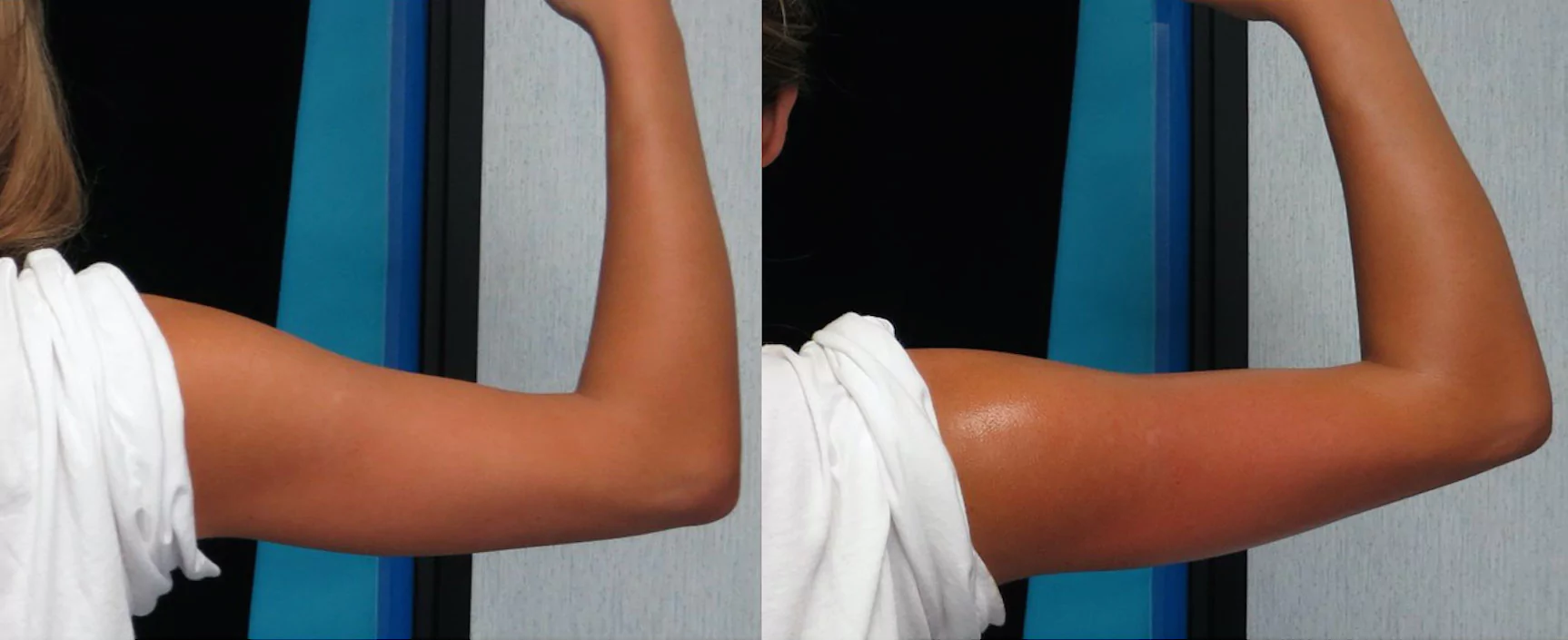 before and after photo of a female patient's right arm that is flatter after 4 sessions of non surgical laser fat melting