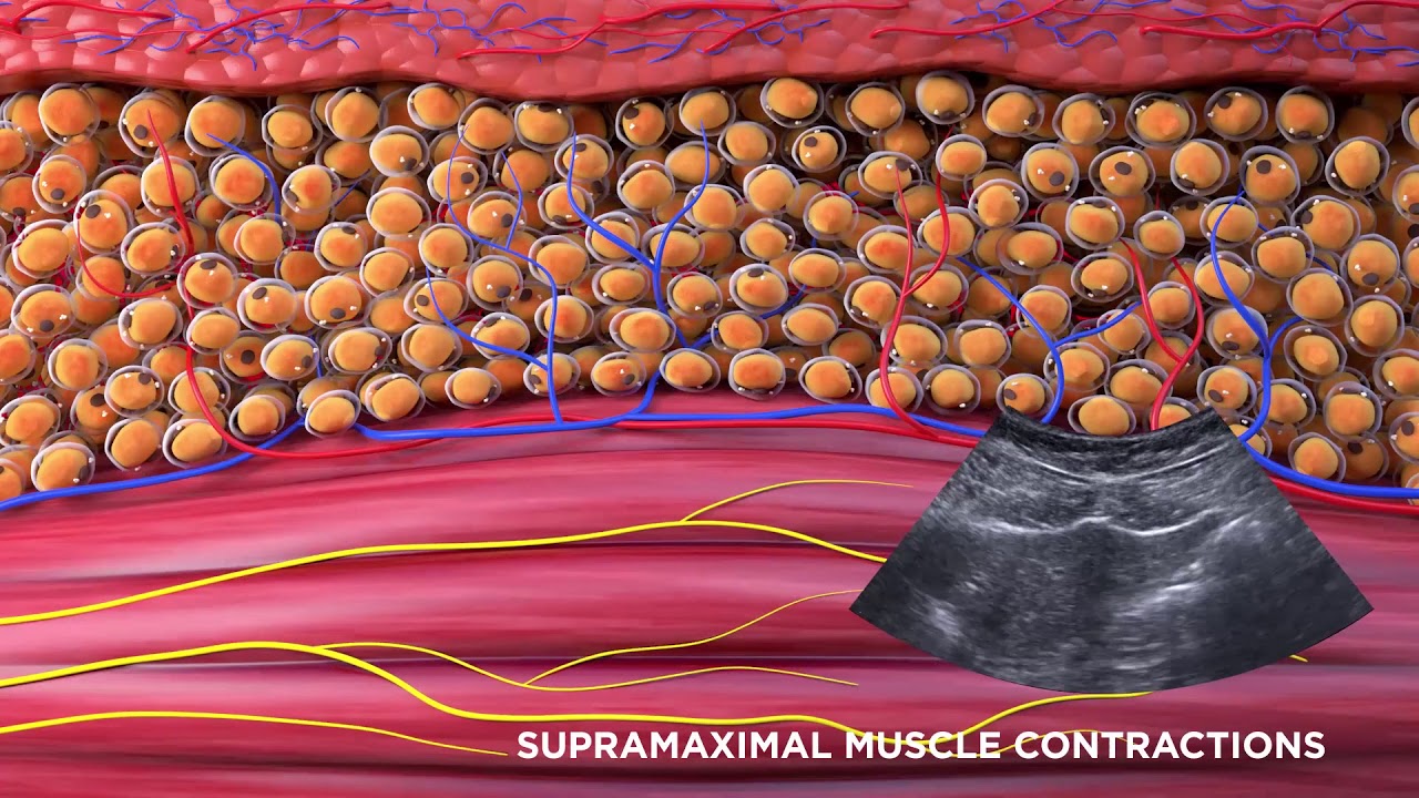 illustration of supramaximal muscle contractions