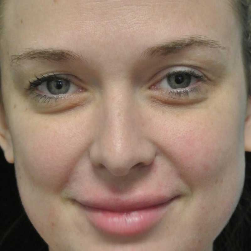 after close up non-smiling photo of a female patient who underwent a lip fillers