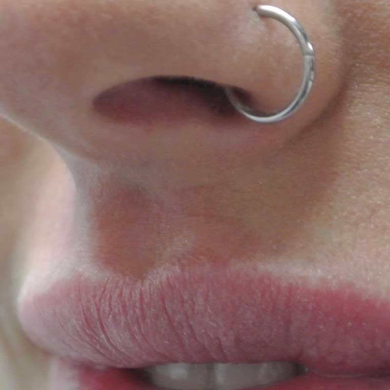 before close up photo of a female patient's upper lip who underwent non surgical lip filler