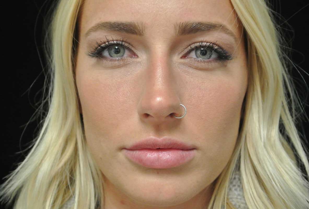 a non smiling female patient who underwent lip fillers