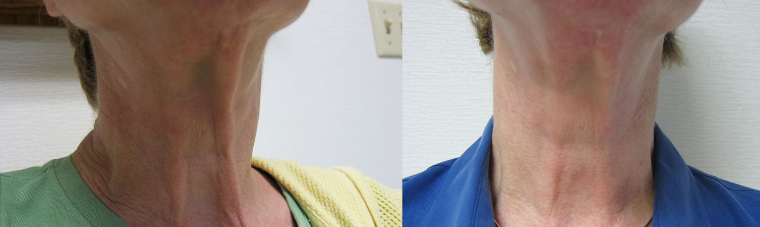before and after photo of on old woman's neck and jowl after 2 sessions of non surgical neck rejuvenation