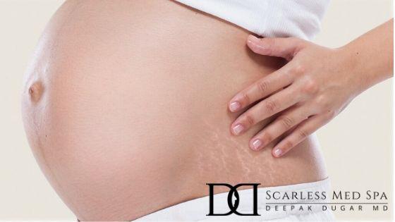 pregnant belly with the logo of Scarless Med Spa on the lower right