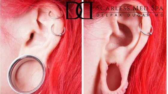 before and after photo of a woman's ear who's wearing a heavy earring