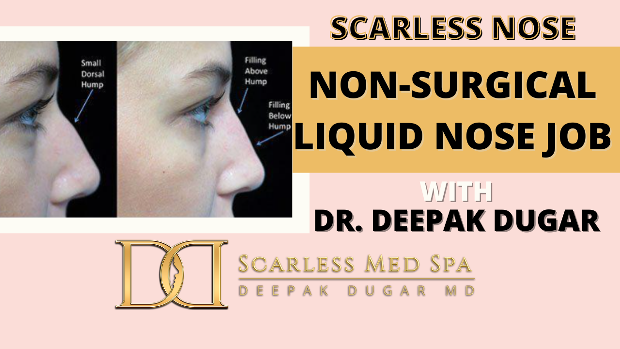Youtube thumbnail of Dr Dugar's video Non-Surgical (Liquid) Nose Job Experience