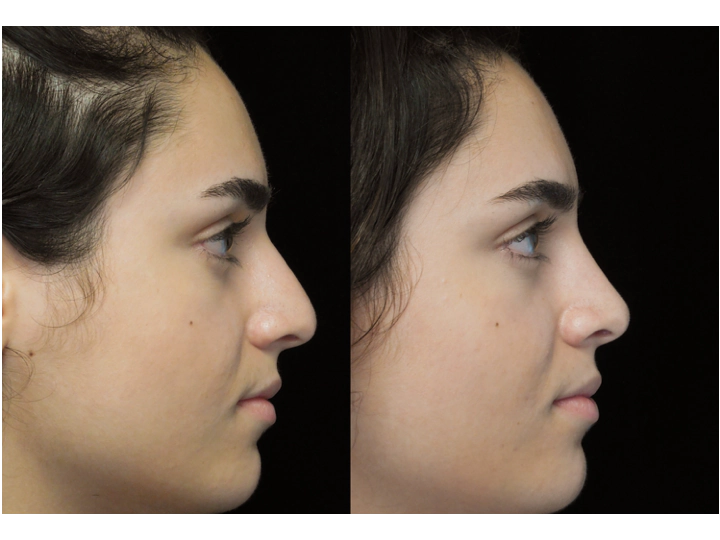 a woman with a bulbous tip who underwent a bulbous tip reduction