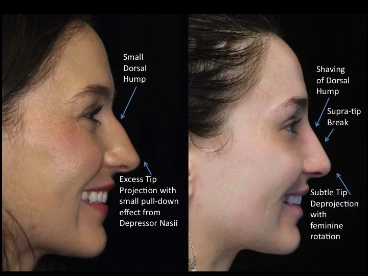closed rhinoplasty before and after photo of a female patient with small dorsal hump