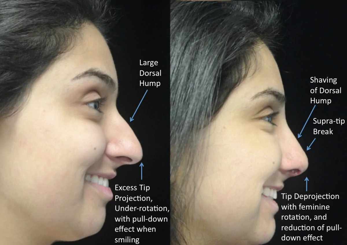 nose job before and after photo illustration of a female patient with large dorsal hump