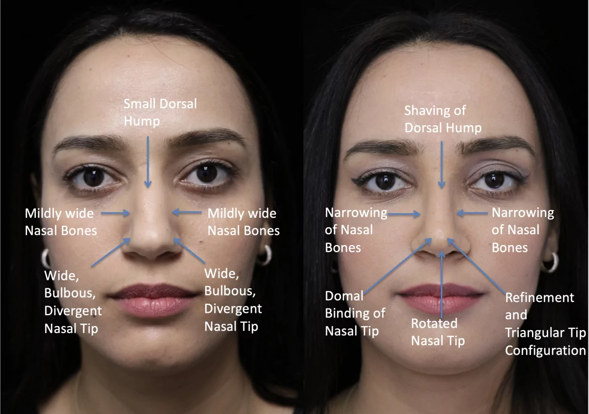 rhinoplasty before and after photo of a female patient with wide nasal bones