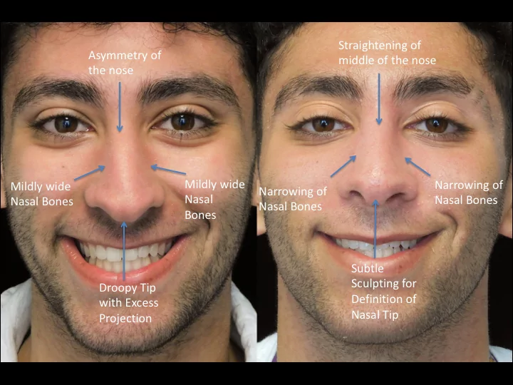 Illustration of a male patient with droopy nose tip who underwent a closed rhinoplasty tip refinement