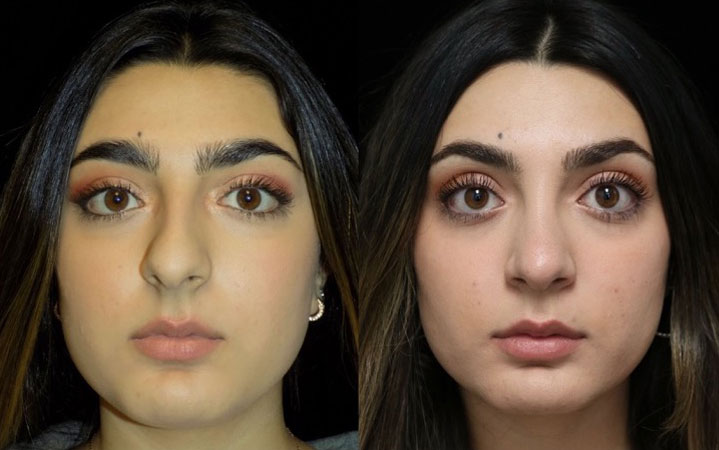 Before and after photo of a closed scarless rhinoplasty female patient