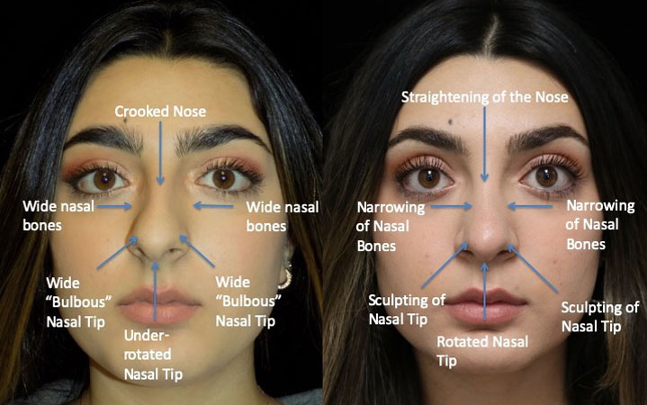 Front view of a female patient after a crooked nose rhinoplasty