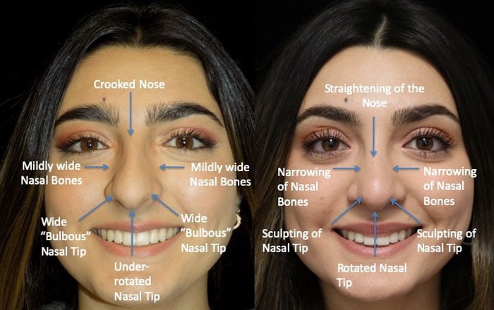 Closed rhinoplasty patient with a straightened nose and rotated nasal tip