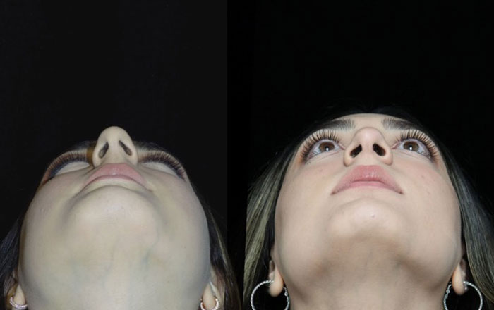 A female rhinplasty patient with a refined nasal tip after closed scarless rhinoplasty