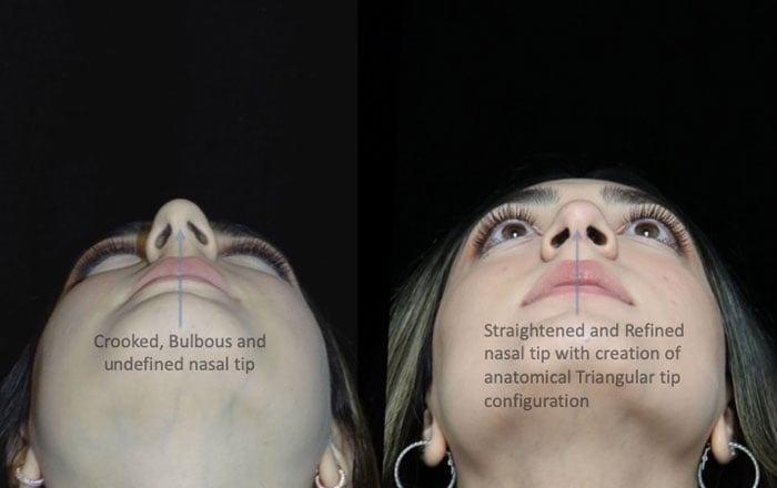 A female rhinplasty patient with a refined nasal tip after closed scarless rhinoplasty