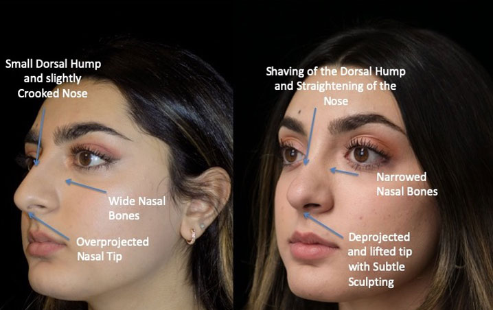 Before and after photo of a closed rhinoplasty patient slightly facing right
