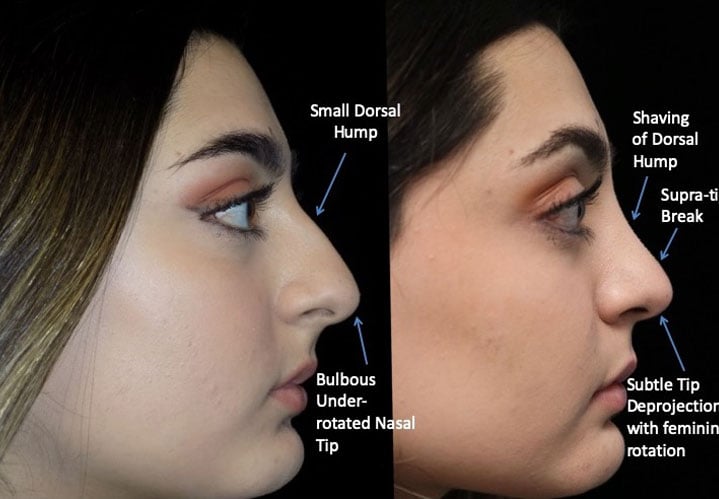 Photo of a female patient facing left after a dorsal hump reduction