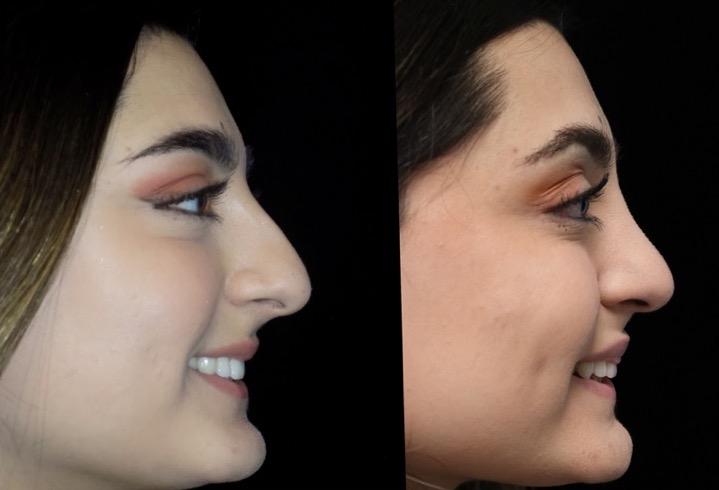 Photo of a closed scarless rhinoplasty patient sllightly facing left