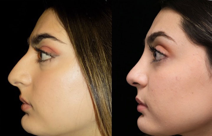closed nose job before and after photo of a female patient facing right