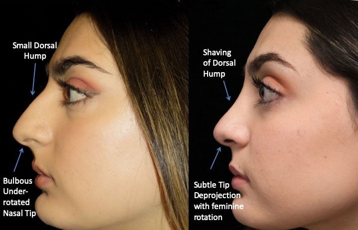 closed nose job before and after photo of a female patient facing right