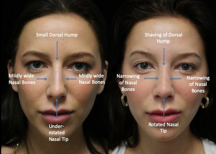 closed nose job before and after photo of a female patient