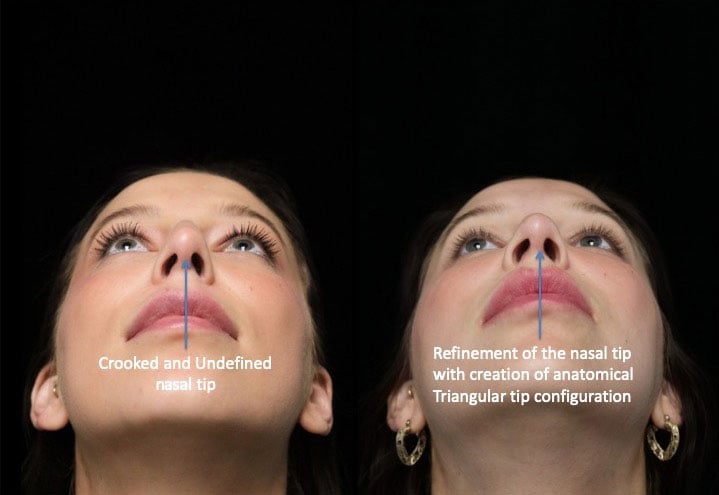 Refined nose tip of a female patient after scarless rhinoplasty